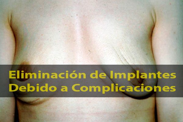 Eliminación de implantes de mama